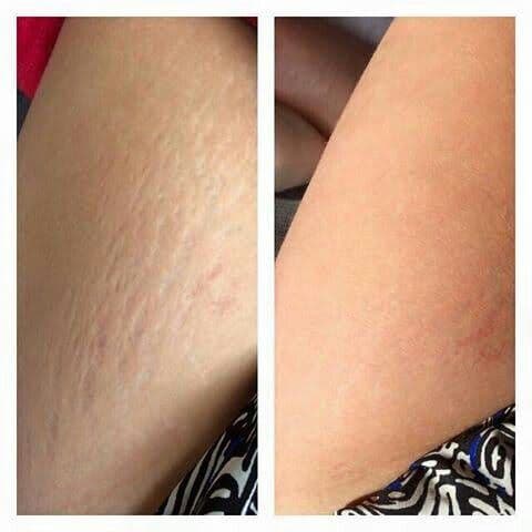 Безмастилна татуировка за стрии и белези - Пълно ръководство 2025